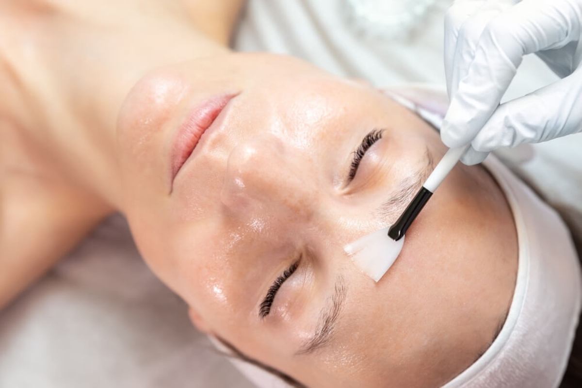peeling chemiczny